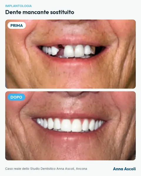 Prima e dopo: Dente mancante sostituito
