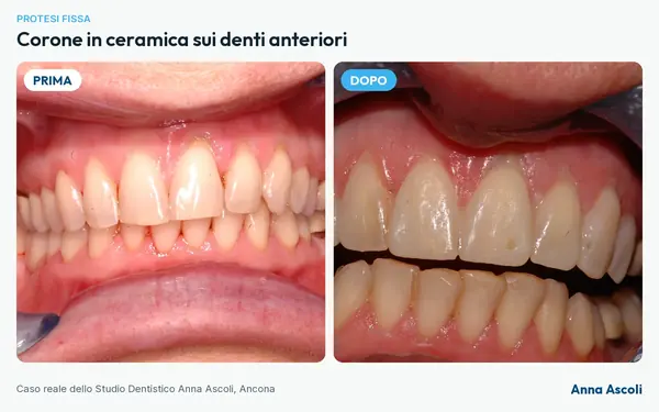 Prima e dopo: Corone in ceramica sui denti anteriori