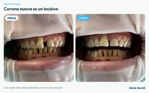 Prima e dopo: Corona nuova su un incisivo