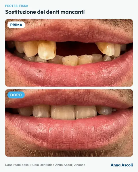 Prima e dopo: Sostituzione dei denti mancanti