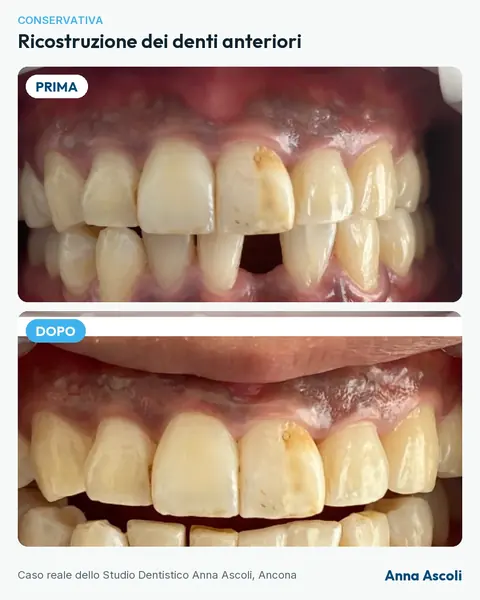 Prima e dopo: Ricostruzione dei denti anteriori