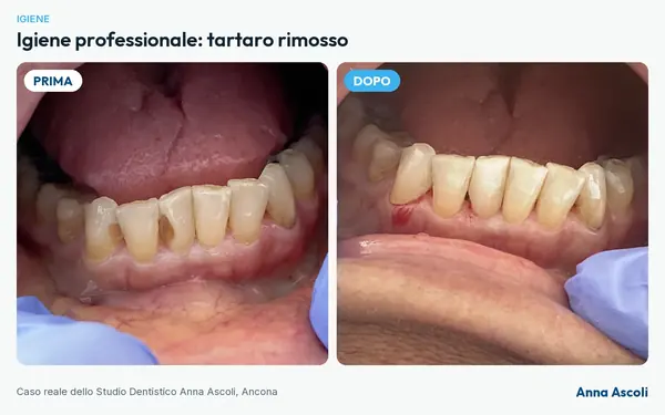Prima e dopo: Igiene professionale: tartaro rimosso