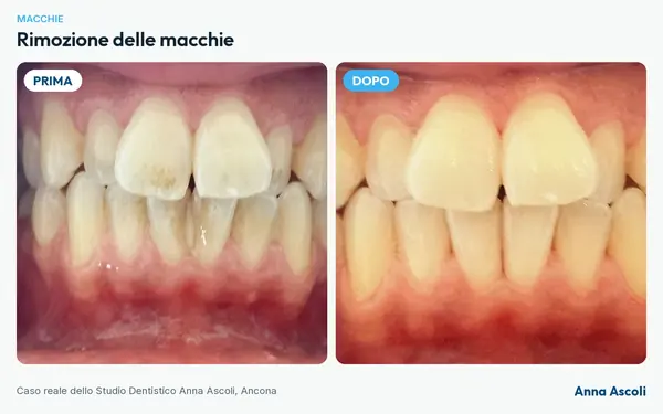 Prima e dopo: Rimozione delle macchie