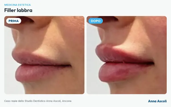 Prima e dopo: Filler labbra
