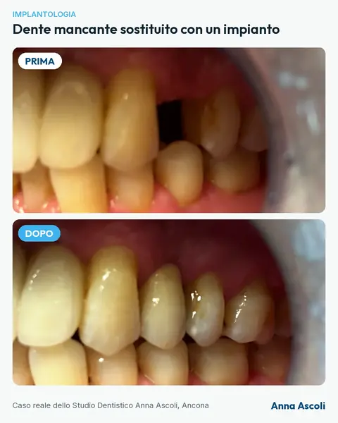 Prima e dopo: Dente mancante sostituito con un impianto