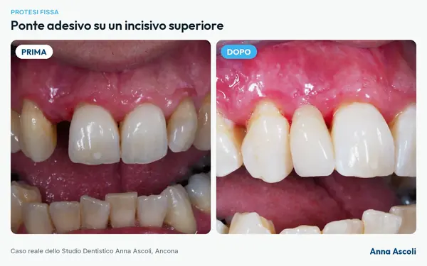 Prima e dopo: Ponte adesivo su un incisivo superiore