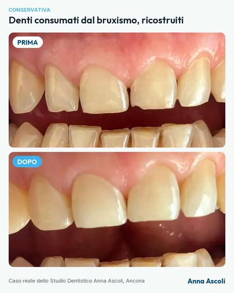 Prima e dopo: Denti consumati dal bruxismo, ricostruiti
