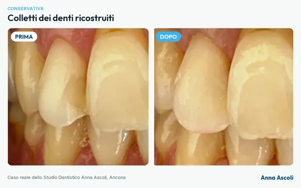 Prima e dopo: Colletti dei denti ricostruiti
