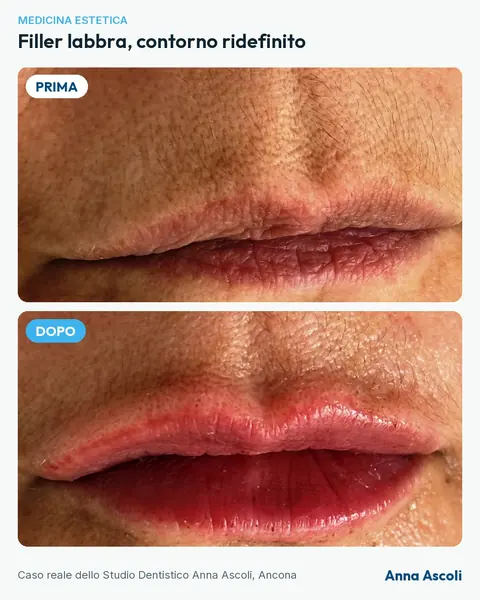 Prima e dopo: Filler labbra, contorno ridefinito