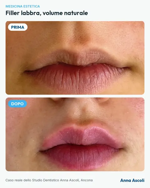 Prima e dopo: Filler labbra, volume naturale