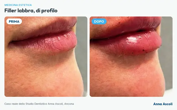 Prima e dopo: Filler labbra, di profilo
