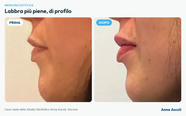 Prima e dopo: Labbra più piene, di profilo