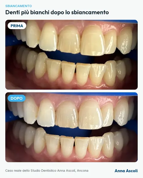 Prima e dopo: Denti più bianchi dopo lo sbiancamento