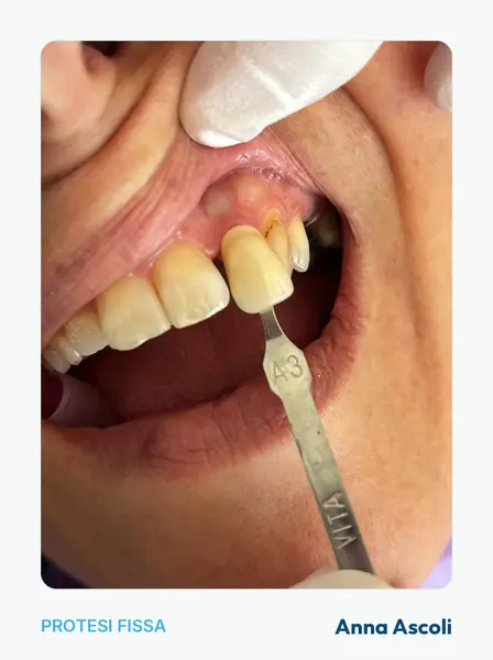 Confronto del colore sul dente