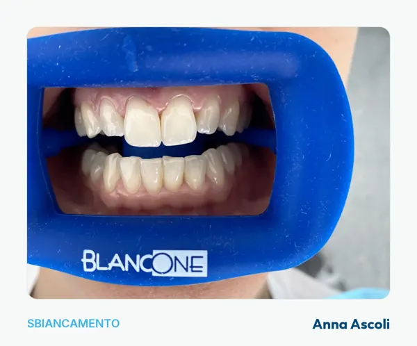 Sbiancamento in studio con la diga di protezione