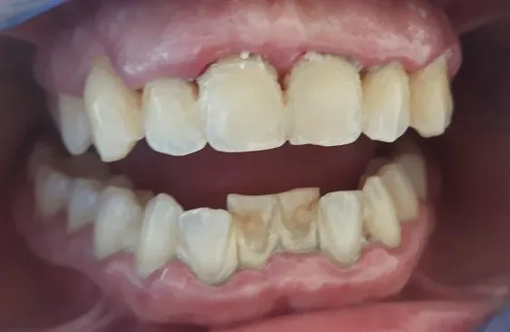 Denti con tartaro prima della pulizia professionale