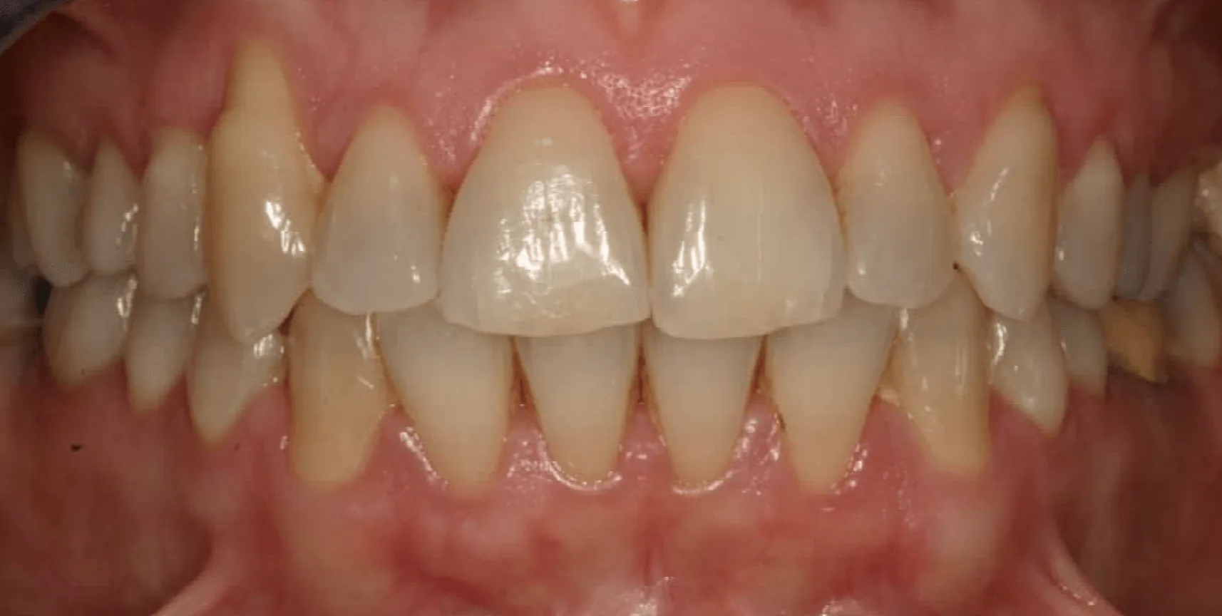 Il sorriso di Sara dopo l'apparecchio fisso: denti allineati