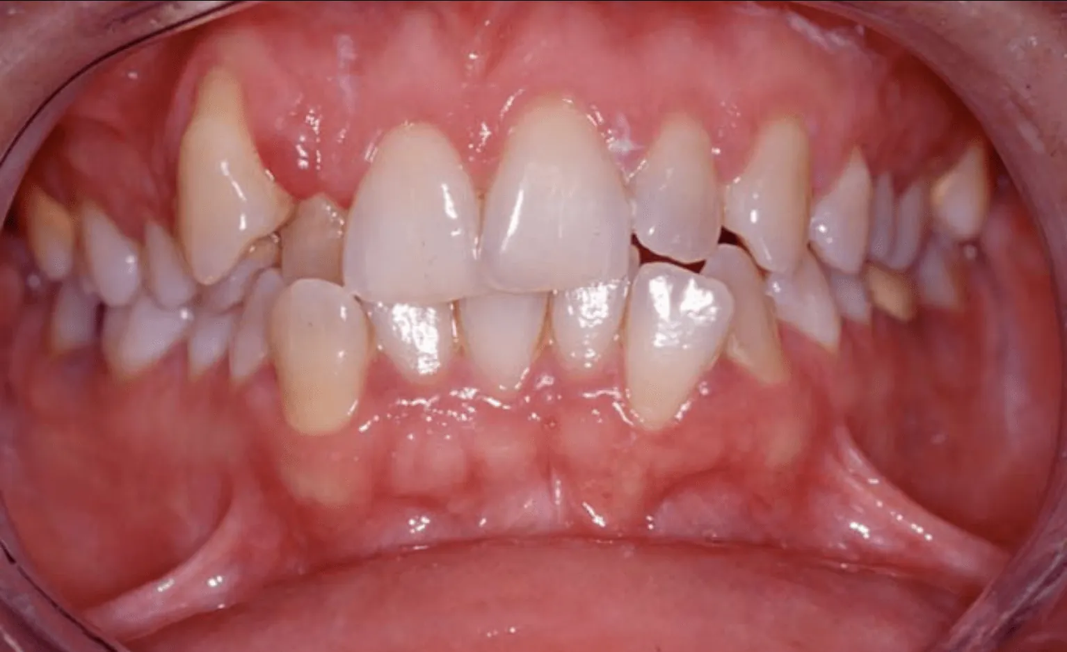 Il sorriso di Sara prima dell'apparecchio: denti affollati