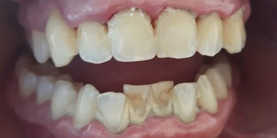 Tartaro nei denti prima di una igiene dentale della dottoressa Anna Ascoli