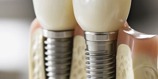 impianti dentali ancona