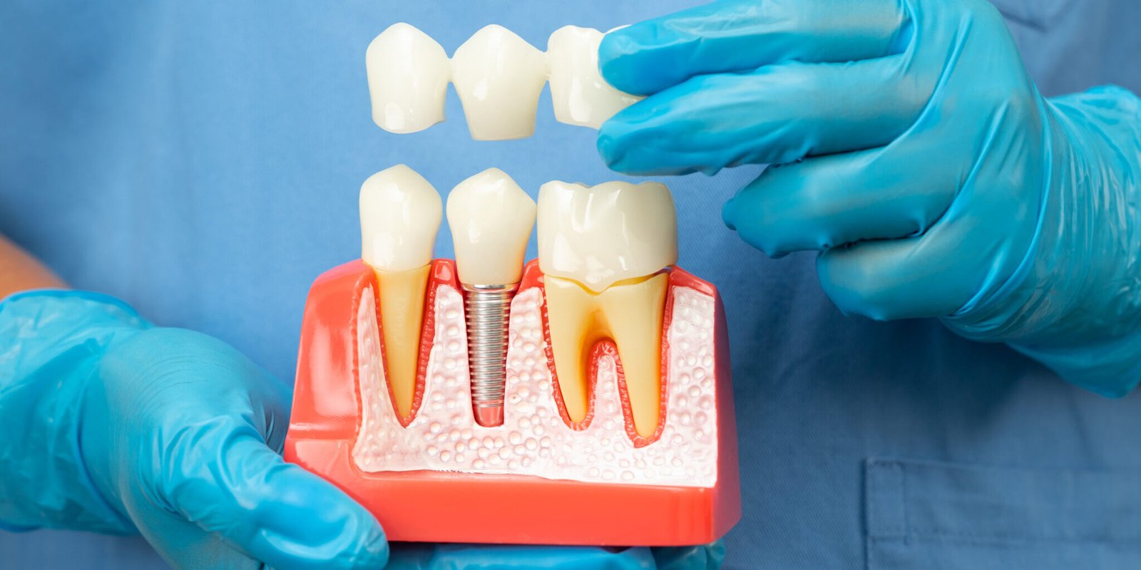 Ponte e impianti dentali Ancona Ponte e impianti dentali Ancona